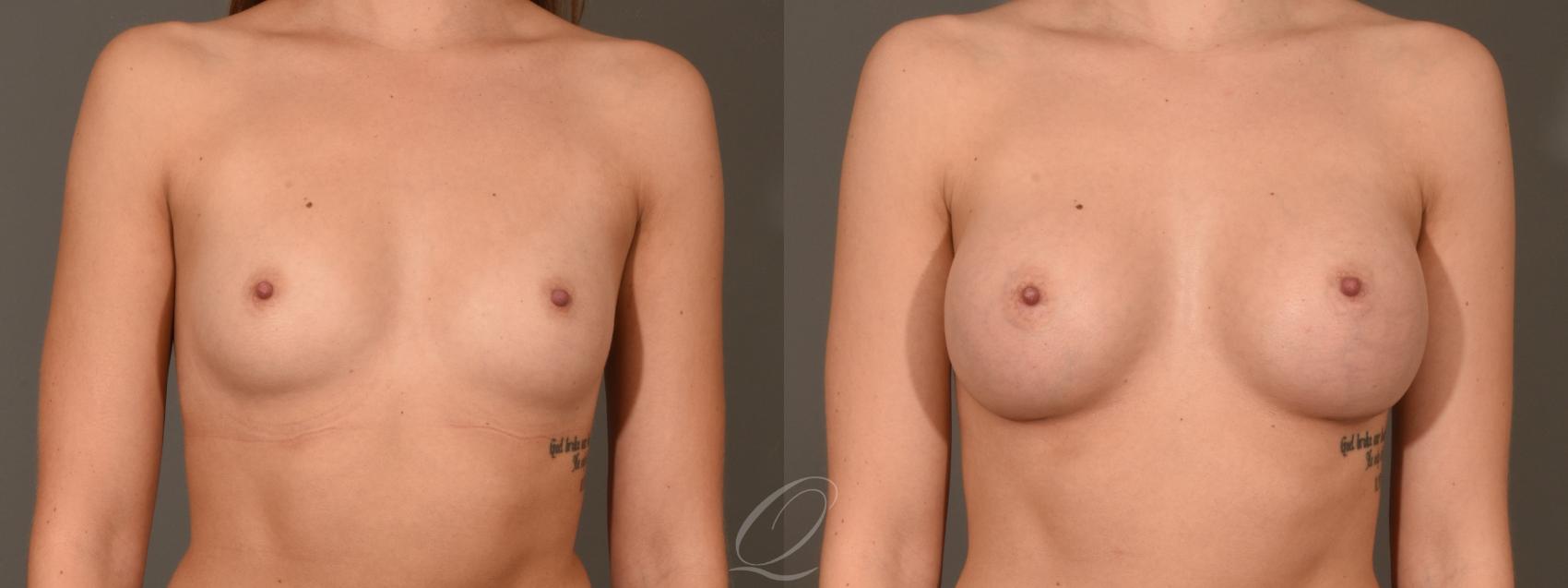 Breast Augmentation Case 1352 Before & After Front | Serving Rochester, Syracuse & Buffalo, NY | Quatela Center for Plastic Surgery