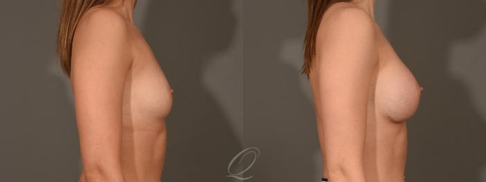 Breast Augmentation Case 1352 Before & After Right Side | Serving Rochester, Syracuse & Buffalo, NY | Quatela Center for Plastic Surgery