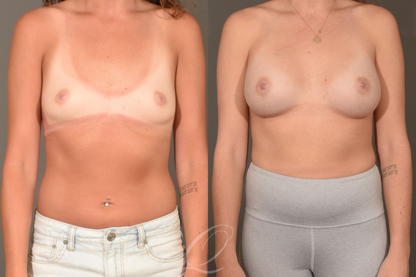 Breast Augmentation Case 1393 Before & After Front | Serving Rochester, Syracuse & Buffalo, NY | Quatela Center for Plastic Surgery