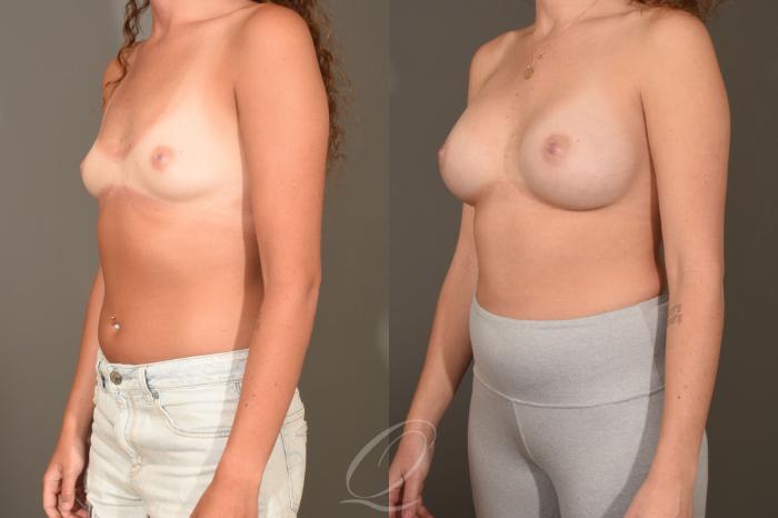 Breast Augmentation Case 1393 Before & After Left Oblique | Serving Rochester, Syracuse & Buffalo, NY | Quatela Center for Plastic Surgery