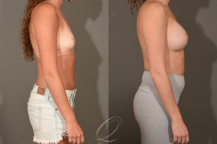 Breast Augmentation Case 1393 Before & After Right Side | Serving Rochester, Syracuse & Buffalo, NY | Quatela Center for Plastic Surgery