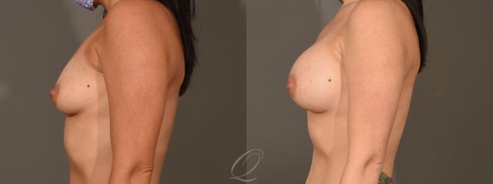 Breast Augmentation Case 1394 Before & After Left Side | Serving Rochester, Syracuse & Buffalo, NY | Quatela Center for Plastic Surgery