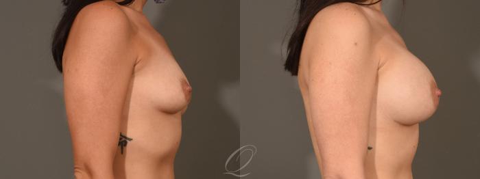 Breast Augmentation Case 1394 Before & After Right Side | Serving Rochester, Syracuse & Buffalo, NY | Quatela Center for Plastic Surgery
