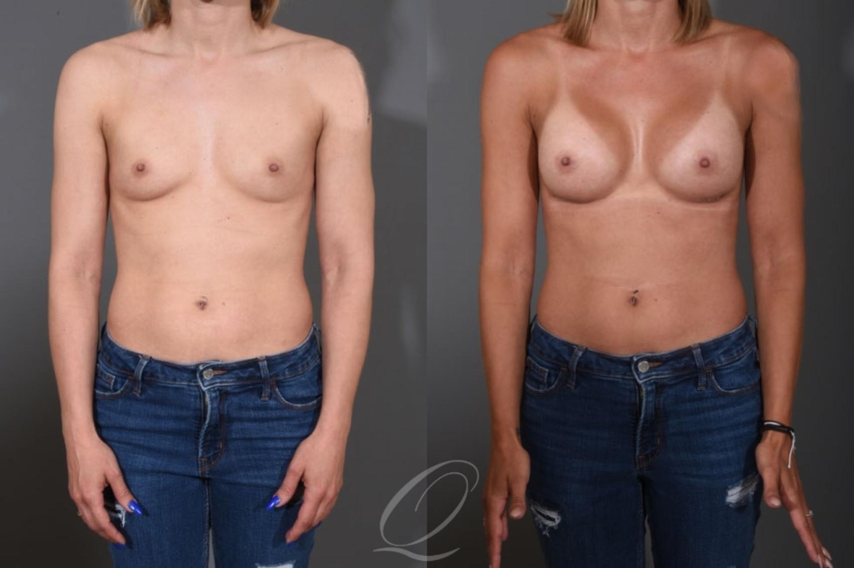 Breast Augmentation Case 1396 Before & After Front | Serving Rochester, Syracuse & Buffalo, NY | Quatela Center for Plastic Surgery