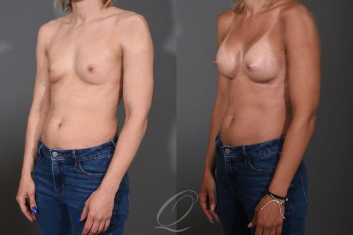 Breast Augmentation Case 1396 Before & After Left Oblique | Serving Rochester, Syracuse & Buffalo, NY | Quatela Center for Plastic Surgery