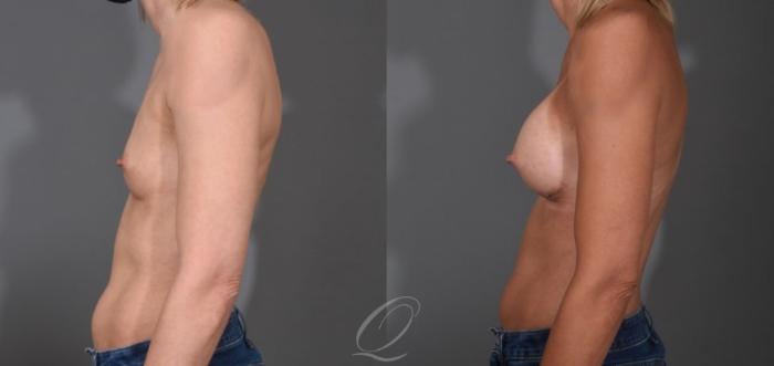 Breast Augmentation Case 1396 Before & After Left Side | Serving Rochester, Syracuse & Buffalo, NY | Quatela Center for Plastic Surgery