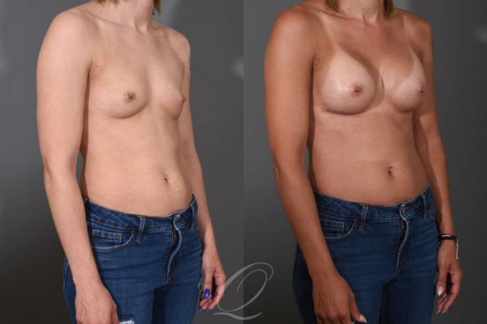 Breast Augmentation Case 1396 Before & After Right Oblique | Serving Rochester, Syracuse & Buffalo, NY | Quatela Center for Plastic Surgery