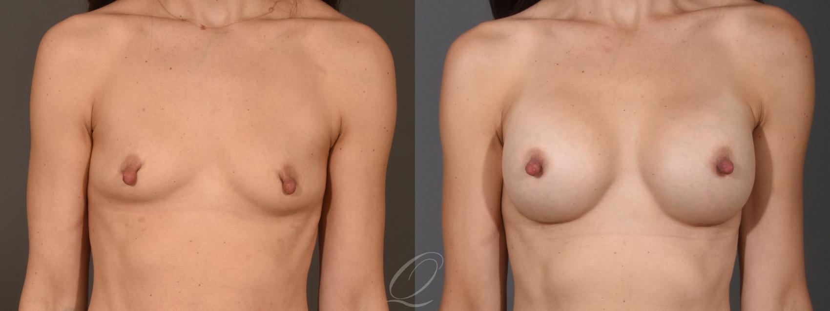 Breast Augmentation Case 1397 Before & After Front | Serving Rochester, Syracuse & Buffalo, NY | Quatela Center for Plastic Surgery
