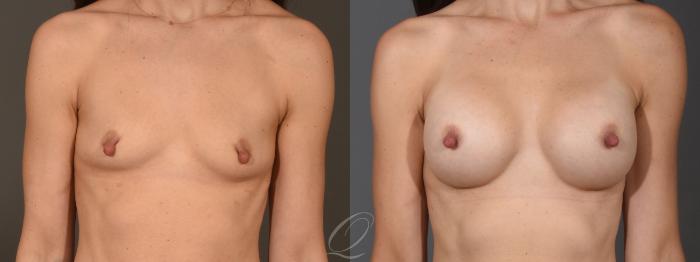 Breast Augmentation Case 1397 Before & After Front | Serving Rochester, Syracuse & Buffalo, NY | Quatela Center for Plastic Surgery