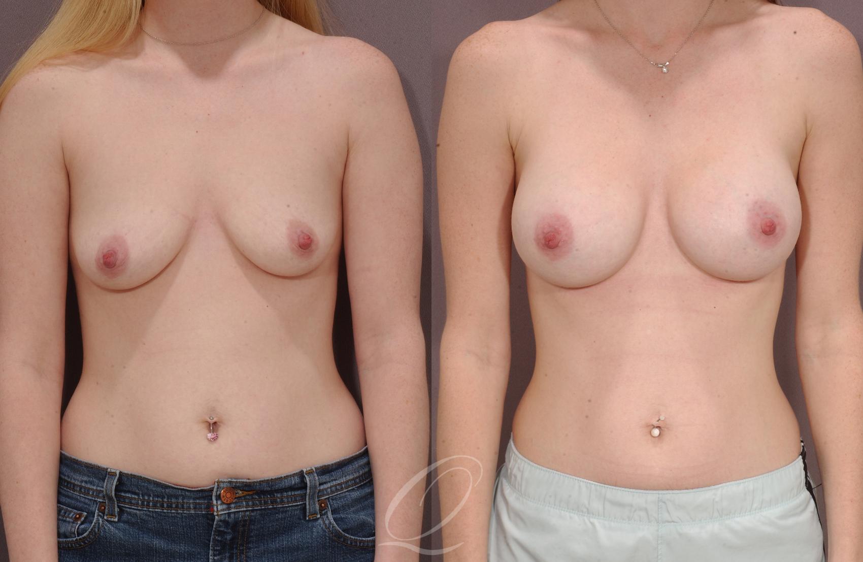 Breast Augmentation Case 140 Before & After View #1 | Serving Rochester, Syracuse & Buffalo, NY | Quatela Center for Plastic Surgery
