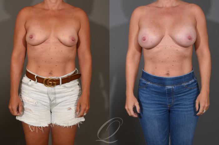 Breast Augmentation Case 1448 Before & After Front | Serving Rochester, Syracuse & Buffalo, NY | Quatela Center for Plastic Surgery
