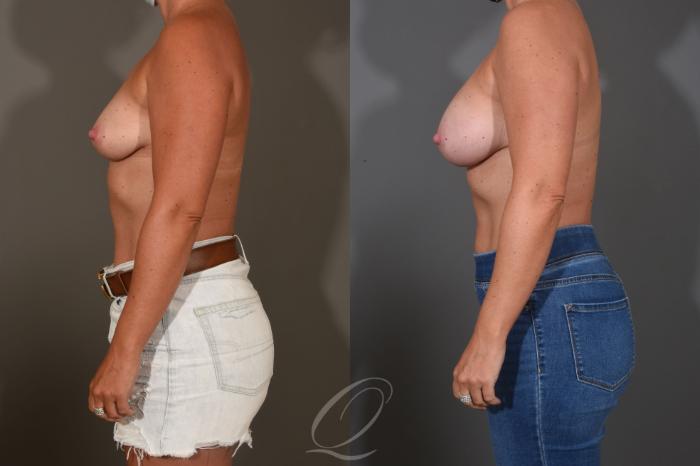 Breast Augmentation Case 1448 Before & After Left Side | Serving Rochester, Syracuse & Buffalo, NY | Quatela Center for Plastic Surgery