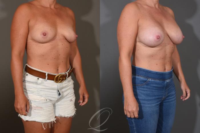 Breast Augmentation Case 1448 Before & After Right Oblique | Serving Rochester, Syracuse & Buffalo, NY | Quatela Center for Plastic Surgery