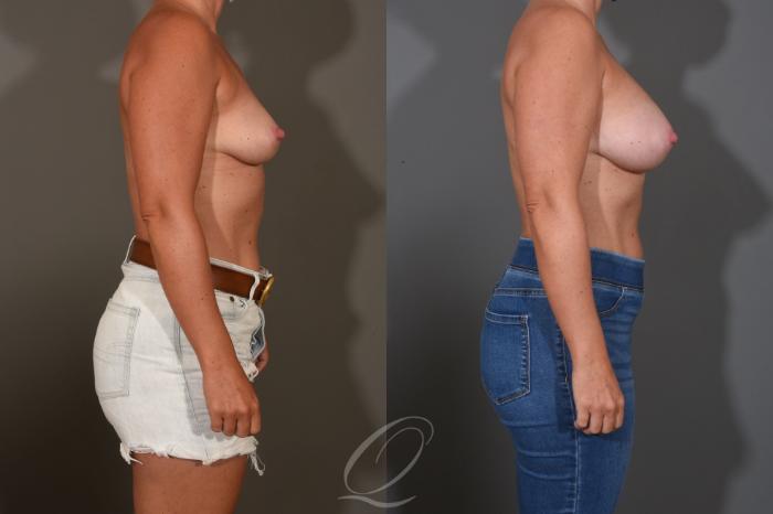 Breast Augmentation Case 1448 Before & After Right Side | Serving Rochester, Syracuse & Buffalo, NY | Quatela Center for Plastic Surgery