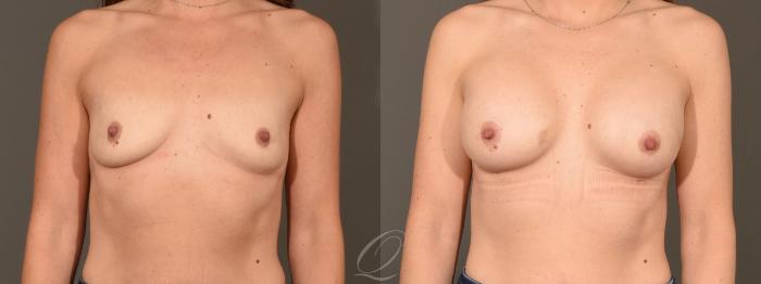Breast Augmentation Case 1449 Before & After Front | Serving Rochester, Syracuse & Buffalo, NY | Quatela Center for Plastic Surgery