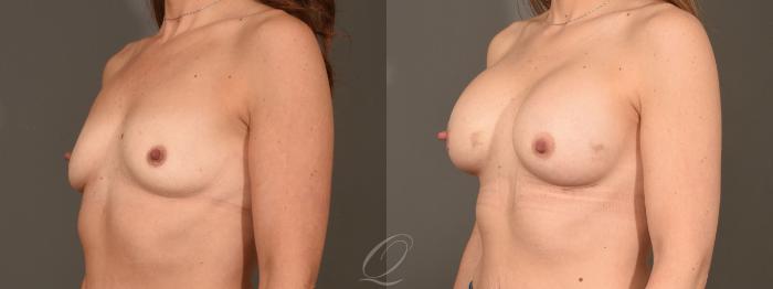 Breast Augmentation Case 1449 Before & After Left Oblique | Serving Rochester, Syracuse & Buffalo, NY | Quatela Center for Plastic Surgery