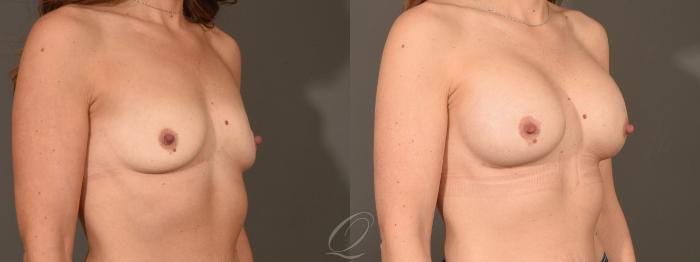 Breast Augmentation Case 1449 Before & After Right Oblique | Serving Rochester, Syracuse & Buffalo, NY | Quatela Center for Plastic Surgery