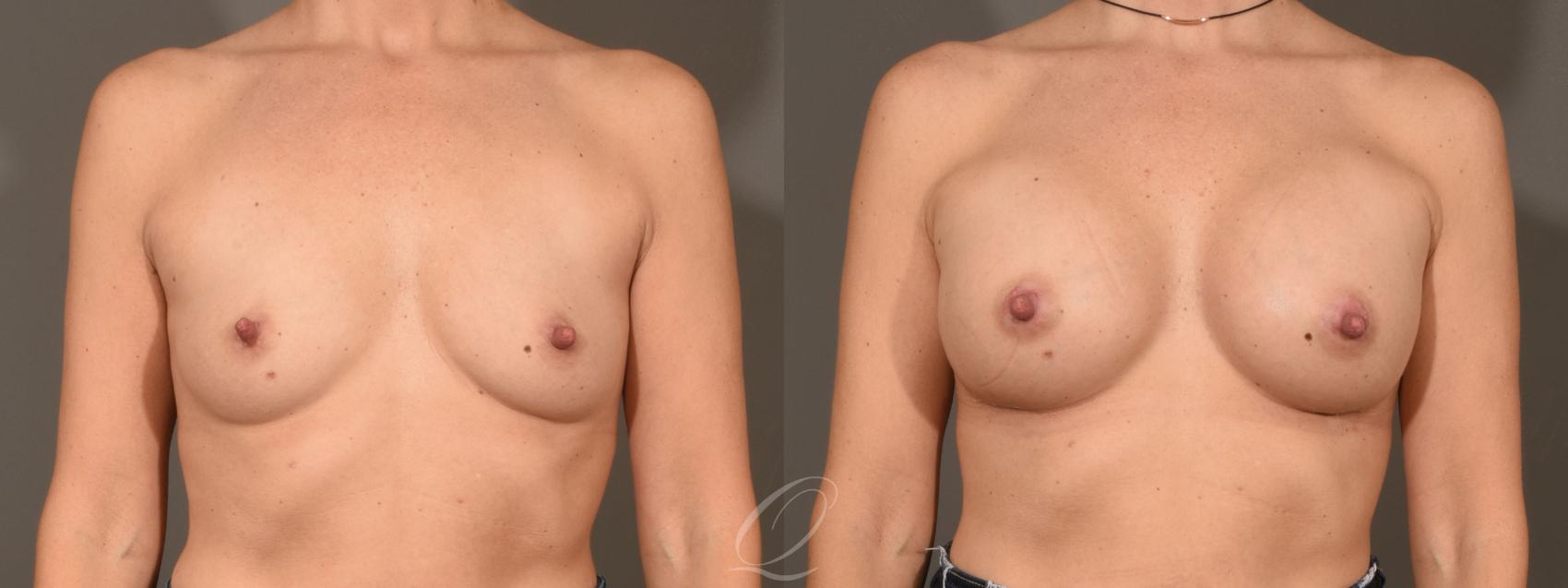 Breast Augmentation Case 1450 Before & After Front | Serving Rochester, Syracuse & Buffalo, NY | Quatela Center for Plastic Surgery
