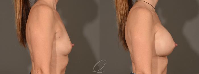 Breast Augmentation Case 1450 Before & After Right Side | Serving Rochester, Syracuse & Buffalo, NY | Quatela Center for Plastic Surgery