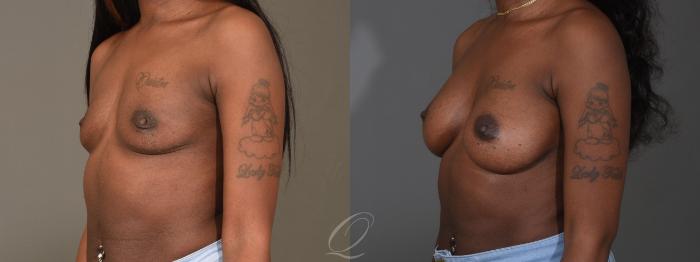 Breast Augmentation Case 1451 Before & After Left Oblique | Serving Rochester, Syracuse & Buffalo, NY | Quatela Center for Plastic Surgery