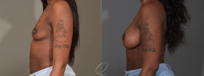 Breast Augmentation Case 1451 Before & After Left Side | Serving Rochester, Syracuse & Buffalo, NY | Quatela Center for Plastic Surgery