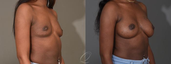 Breast Augmentation Case 1451 Before & After Right Oblique | Serving Rochester, Syracuse & Buffalo, NY | Quatela Center for Plastic Surgery