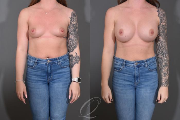 Breast Augmentation Case 1452 Before & After Front | Serving Rochester, Syracuse & Buffalo, NY | Quatela Center for Plastic Surgery