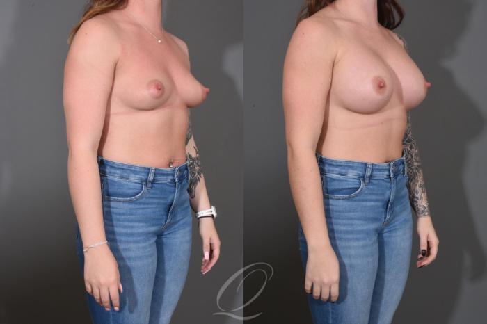 Breast Augmentation Case 1452 Before & After Right Oblique | Serving Rochester, Syracuse & Buffalo, NY | Quatela Center for Plastic Surgery