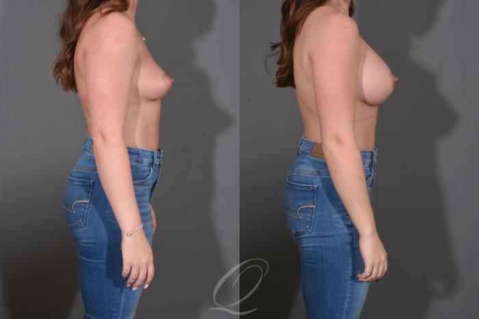 Breast Augmentation Case 1452 Before & After Right Side | Serving Rochester, Syracuse & Buffalo, NY | Quatela Center for Plastic Surgery