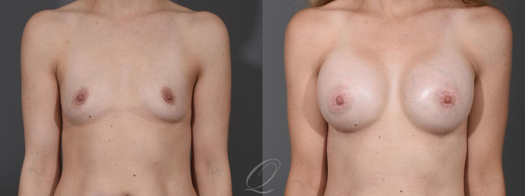 Breast Augmentation Case 1453 Before & After Front | Serving Rochester, Syracuse & Buffalo, NY | Quatela Center for Plastic Surgery
