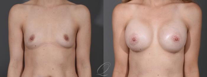 Breast Augmentation Case 1453 Before & After Front | Serving Rochester, Syracuse & Buffalo, NY | Quatela Center for Plastic Surgery