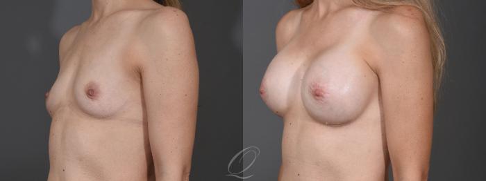 Breast Augmentation Case 1453 Before & After Left Oblique | Serving Rochester, Syracuse & Buffalo, NY | Quatela Center for Plastic Surgery
