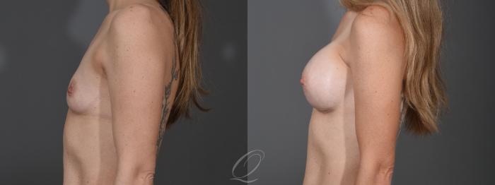 Breast Augmentation Case 1453 Before & After Left Side | Serving Rochester, Syracuse & Buffalo, NY | Quatela Center for Plastic Surgery