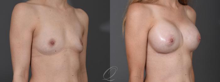 Breast Augmentation Case 1453 Before & After Right Oblique | Serving Rochester, Syracuse & Buffalo, NY | Quatela Center for Plastic Surgery