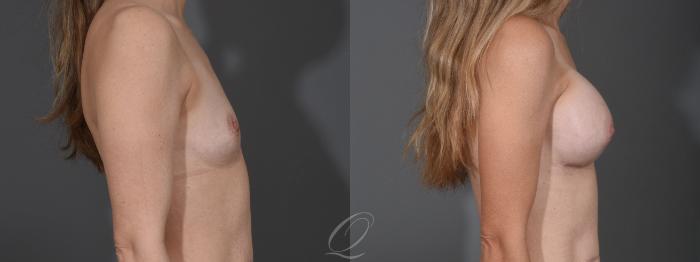 Breast Augmentation Case 1453 Before & After Right Side | Serving Rochester, Syracuse & Buffalo, NY | Quatela Center for Plastic Surgery