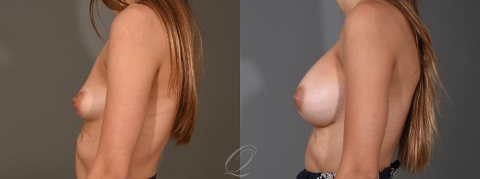 Breast Augmentation Case 1454 Before & After Left Side | Serving Rochester, Syracuse & Buffalo, NY | Quatela Center for Plastic Surgery