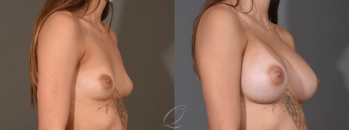Breast Augmentation Case 1454 Before & After Right Oblique | Serving Rochester, Syracuse & Buffalo, NY | Quatela Center for Plastic Surgery