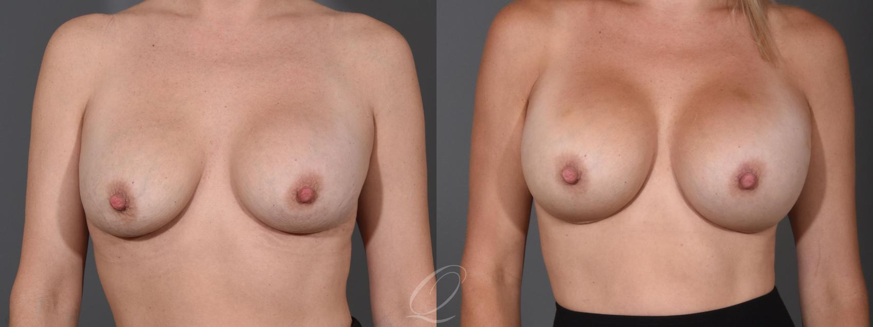Breast Augmentation Case 1455 Before & After Front | Serving Rochester, Syracuse & Buffalo, NY | Quatela Center for Plastic Surgery