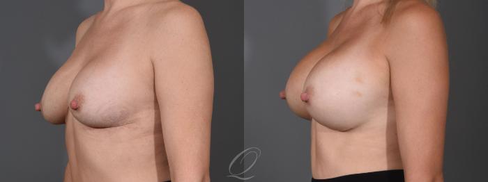 Breast Augmentation Case 1455 Before & After Left Oblique | Serving Rochester, Syracuse & Buffalo, NY | Quatela Center for Plastic Surgery