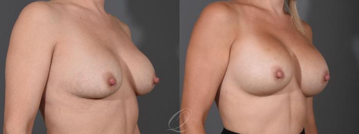 Breast Augmentation Case 1455 Before & After Right Oblique | Serving Rochester, Syracuse & Buffalo, NY | Quatela Center for Plastic Surgery