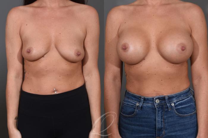 Breast Augmentation Case 1456 Before & After Front | Serving Rochester, Syracuse & Buffalo, NY | Quatela Center for Plastic Surgery