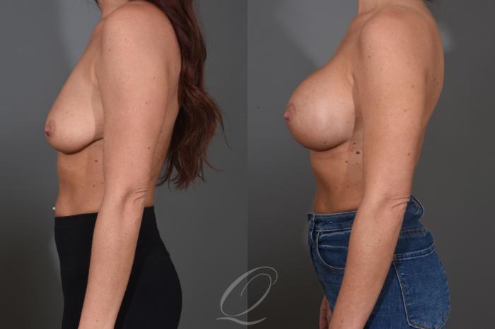 Breast Augmentation Case 1456 Before & After Left Side | Serving Rochester, Syracuse & Buffalo, NY | Quatela Center for Plastic Surgery
