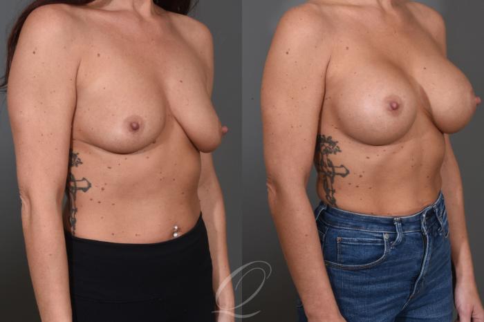 Breast Augmentation Case 1456 Before & After Right Oblique | Serving Rochester, Syracuse & Buffalo, NY | Quatela Center for Plastic Surgery