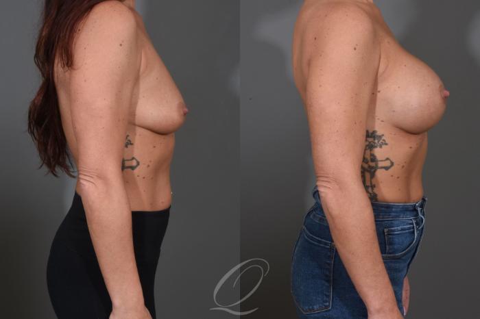 Breast Augmentation Case 1456 Before & After Right Side | Serving Rochester, Syracuse & Buffalo, NY | Quatela Center for Plastic Surgery