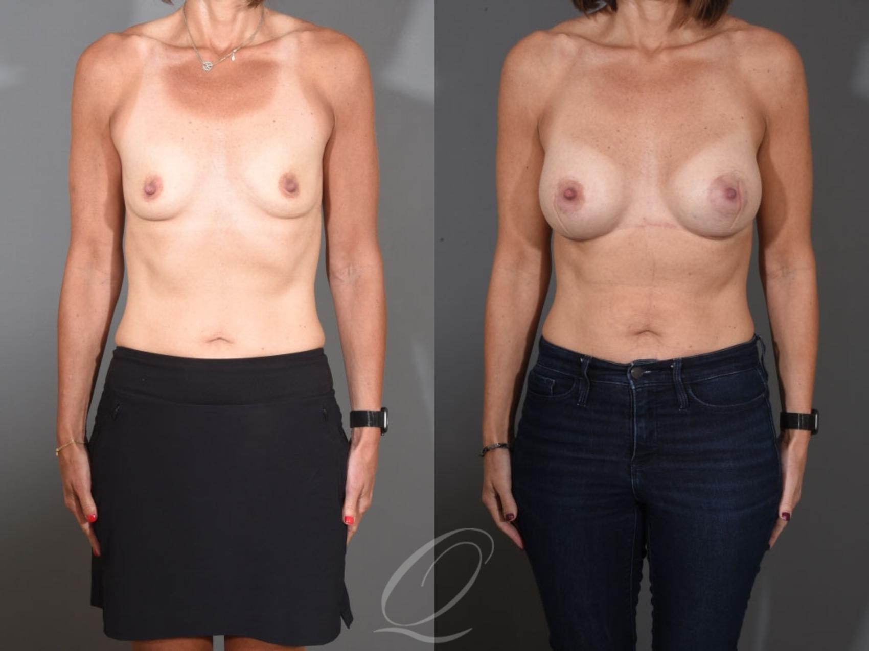 Breast Augmentation Case 1457 Before & After Front | Serving Rochester, Syracuse & Buffalo, NY | Quatela Center for Plastic Surgery