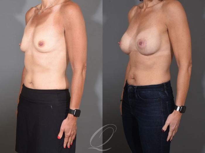 Breast Augmentation Case 1457 Before & After Left Oblique | Serving Rochester, Syracuse & Buffalo, NY | Quatela Center for Plastic Surgery
