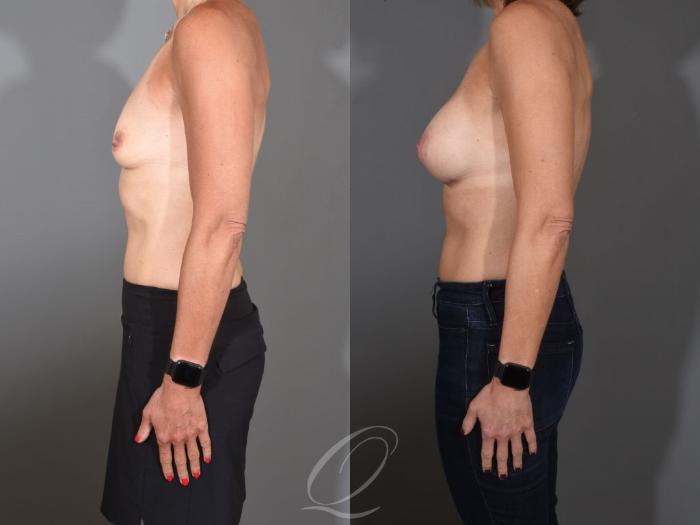 Breast Augmentation Case 1457 Before & After Left Side | Serving Rochester, Syracuse & Buffalo, NY | Quatela Center for Plastic Surgery