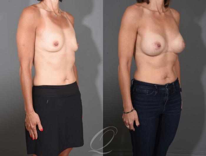 Breast Augmentation Case 1457 Before & After Right Oblique | Serving Rochester, Syracuse & Buffalo, NY | Quatela Center for Plastic Surgery