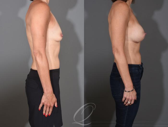 Breast Augmentation Case 1457 Before & After Right Side | Serving Rochester, Syracuse & Buffalo, NY | Quatela Center for Plastic Surgery