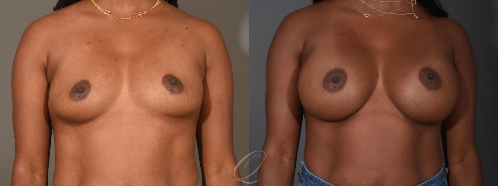 Breast Augmentation Case 1458 Before & After Front | Serving Rochester, Syracuse & Buffalo, NY | Quatela Center for Plastic Surgery